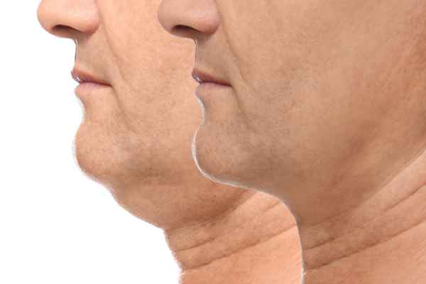 HIFU - Breakthrough in Anti - ageing 2 hifu results St Albans