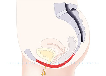 Pelvic-Floor Muscle Repair 5 Pelvic floor muscles St Albans