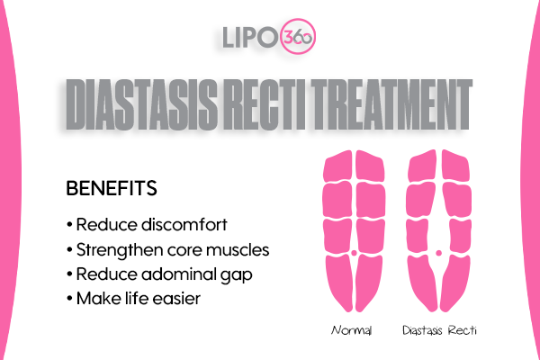 Revolutionising Muscle Repair: The Power of LIPO360 Body Sculpt Post-Injury 5 diastasis recti treatment St Albans