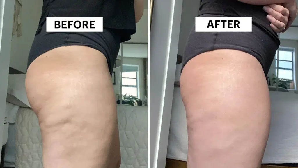 Sculpting Your Bum: Can Toning Exercises Really Reduce Cellulite? 1 Do Toning Exercise St Albans Really Tackle Cellulite?