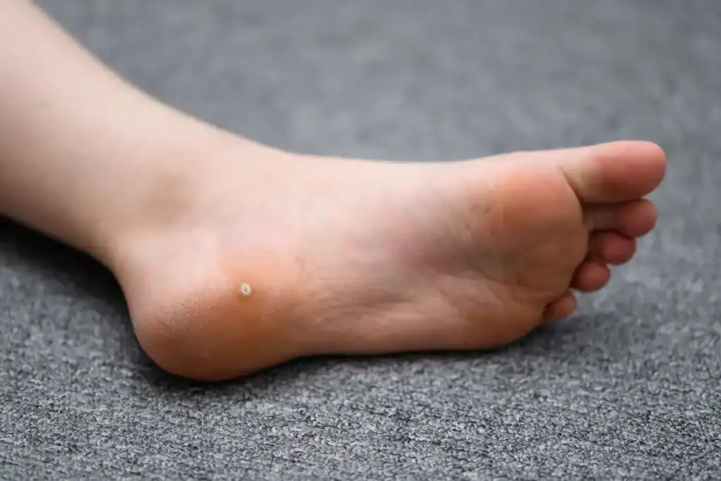 Cryotherapy For Warts And Also Verrucas 2 Image of verruca on the bottom of the foot that able to be treated with Cryotherapy St Albans