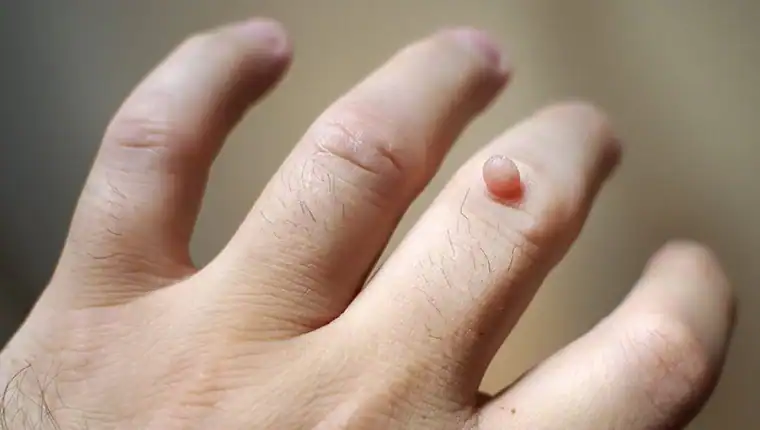 Cryotherapy For Warts And Also Verrucas 1 Image of blemish that Cryotherapy St Albans can remove with Lipo 360.