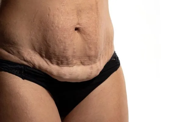 The science behind skin tightening St Albans picture of a woman's sagging skin on the stomach